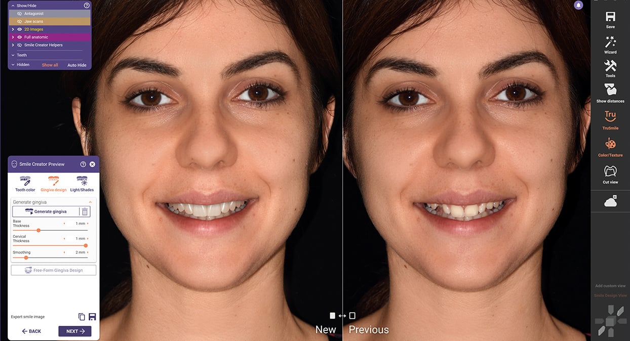 exocad image 4